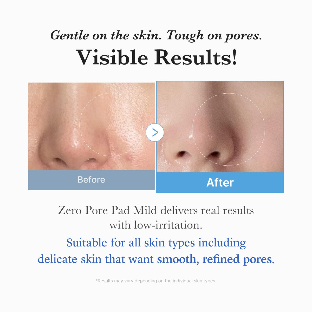 Zero Pore Madecassoside Pads (Mild) — 5